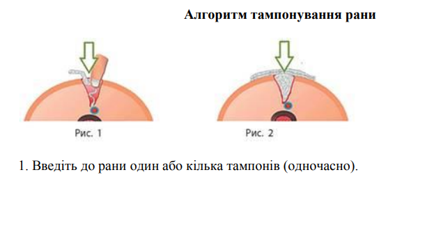 Алгоритм тампонування рани