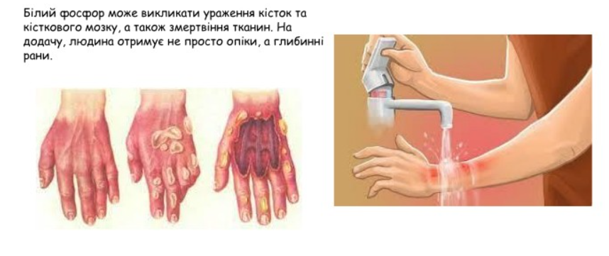 Як надавати першу медичну допомогу при фосфорних опіках